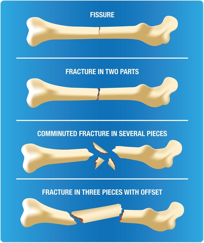 Illustration of a bone skeleton illustrating various types of fractures. Image Credit: Luciano Cosmo / Shutterstock